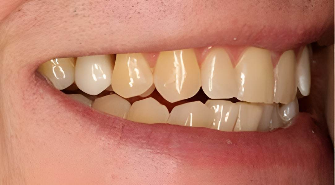 After dental implants treatment