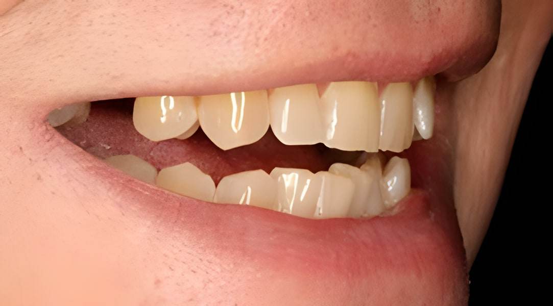 Before dental implants treatment