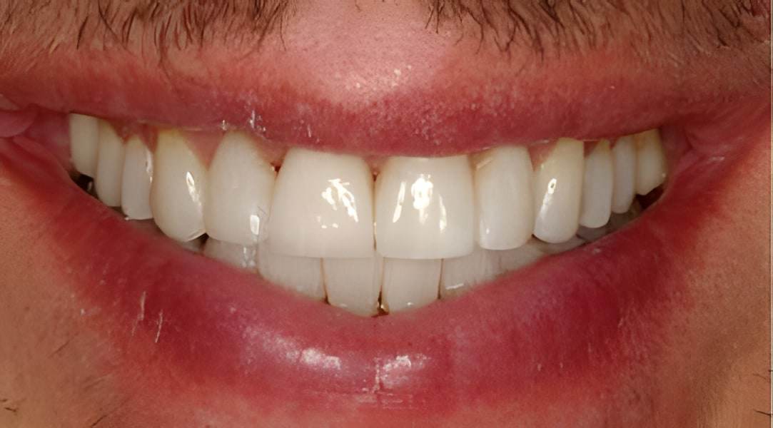 After veneers treatment