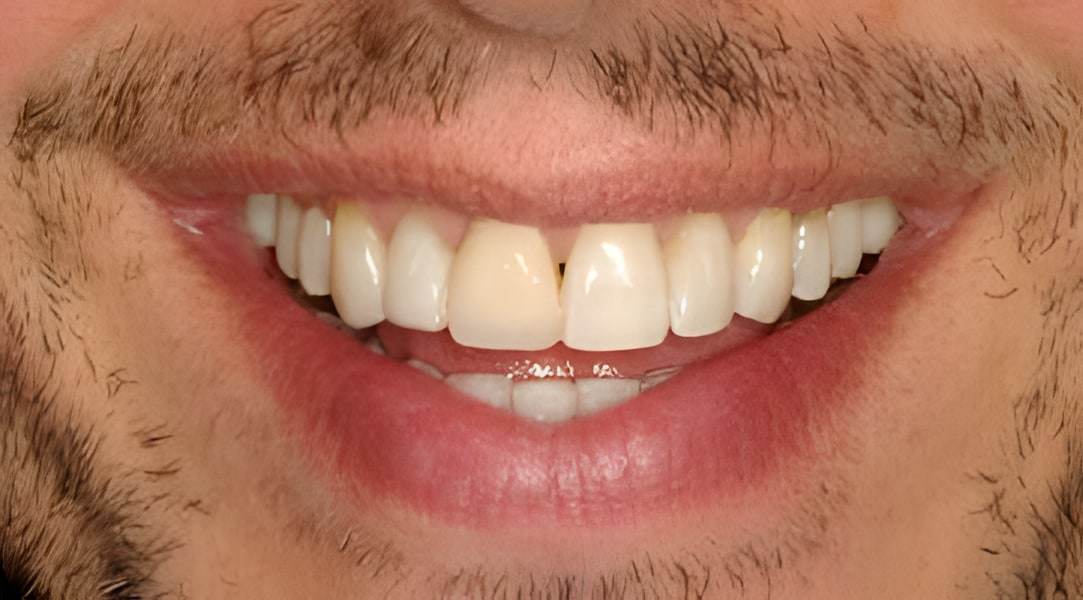 Before veneers treatment