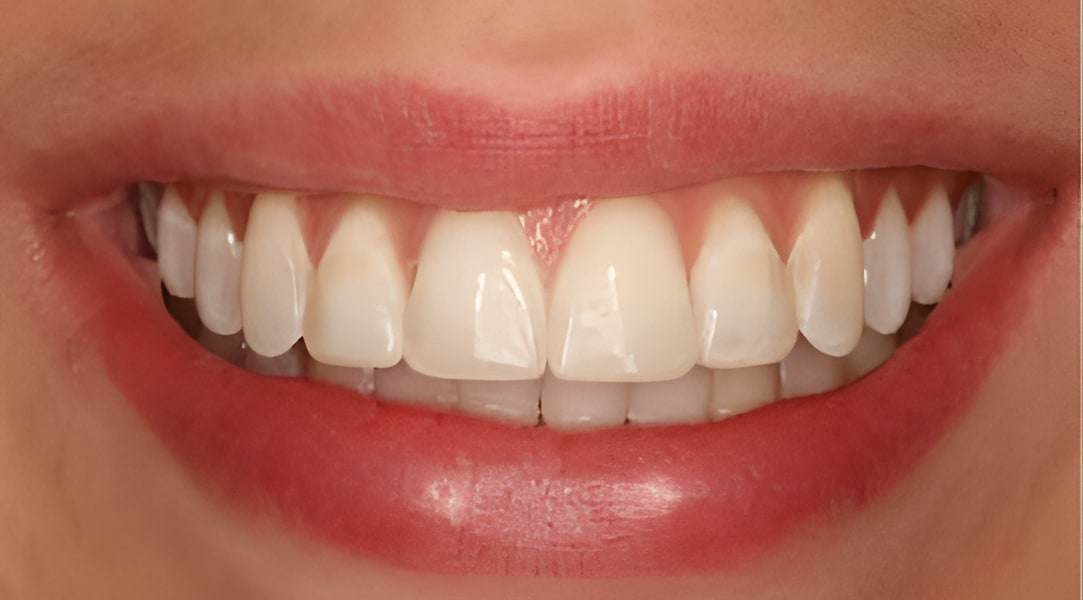 After smile makeover treatment