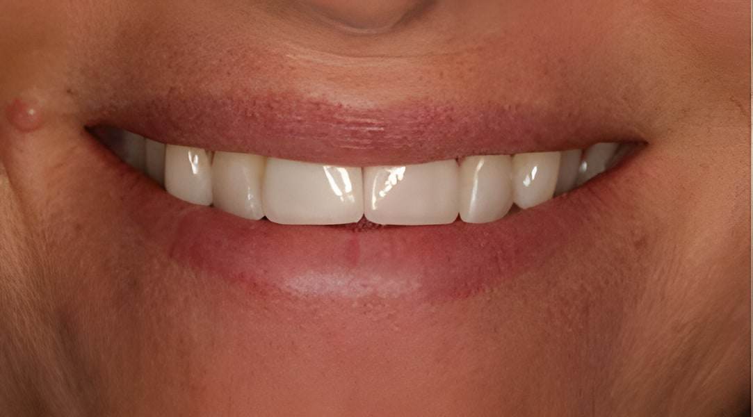 After dental implants treatment