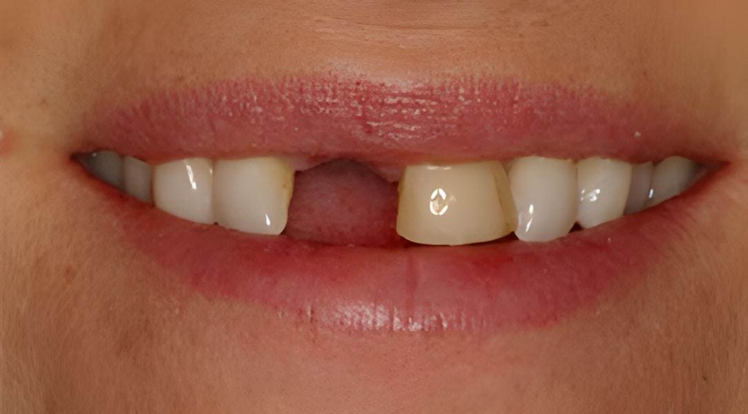 Before dental implants treatment