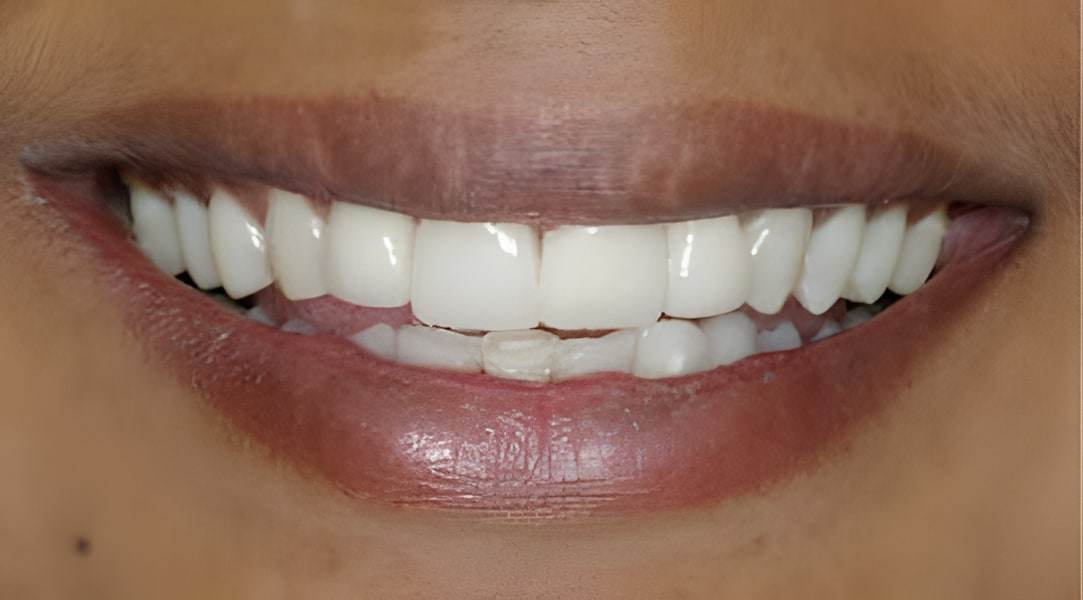 After veneers treatment