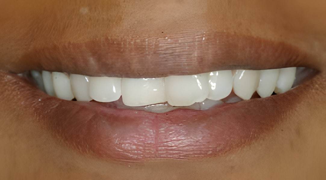 Before veneers treatment
