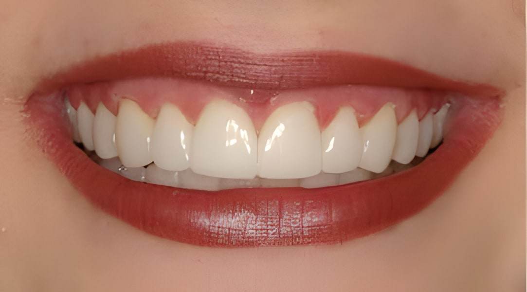 After smile makeover treatment