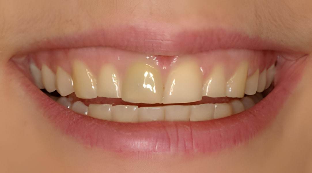 Before smile makeover treatment