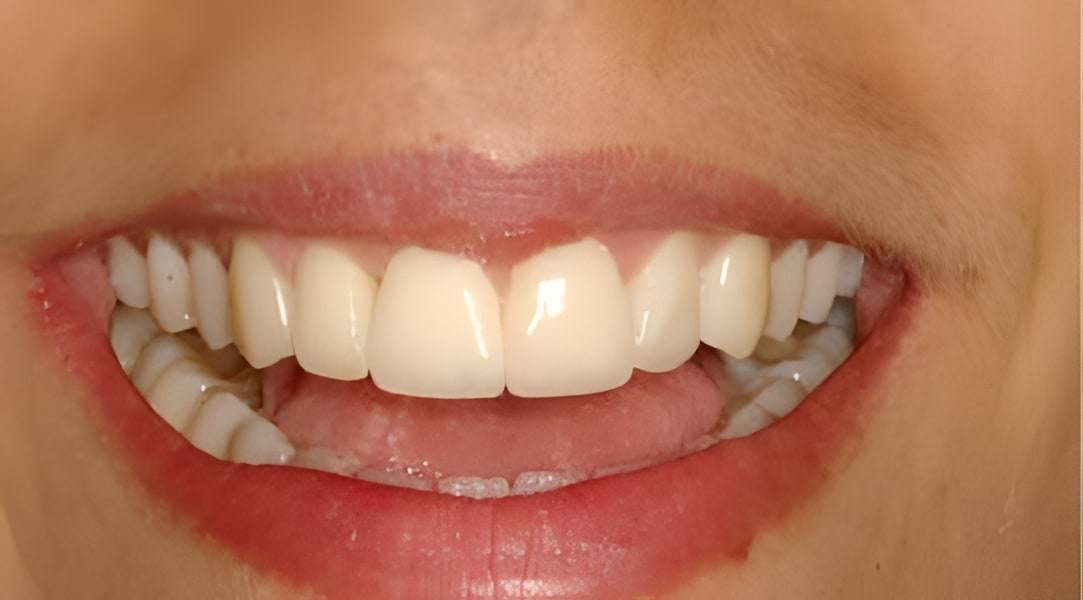 After dental implants treatment