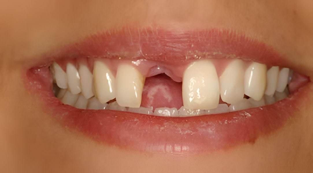 Before dental implants treatment