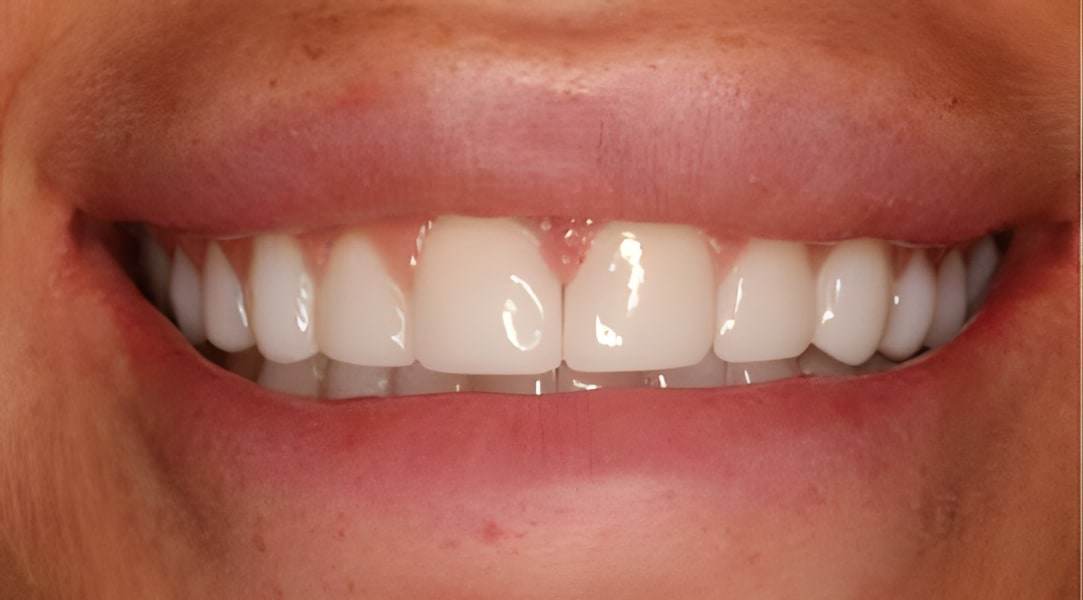 After cosmetic bonding treatment
