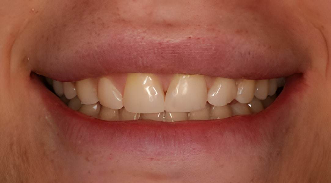 Before cosmetic bonding treatment